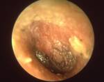 Otitis media, or inflammation of the inner ear, is caused by biofilm.
