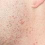 acne.jpg
