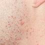 acne.jpg
