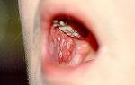 Herpes simplex infection